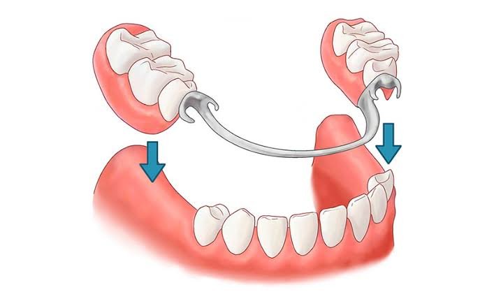 Implantes o prótesis dentales.